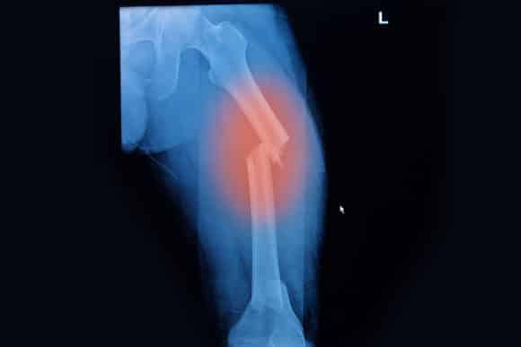 fosamax-lawsuit-femure-fracture-risks-complications