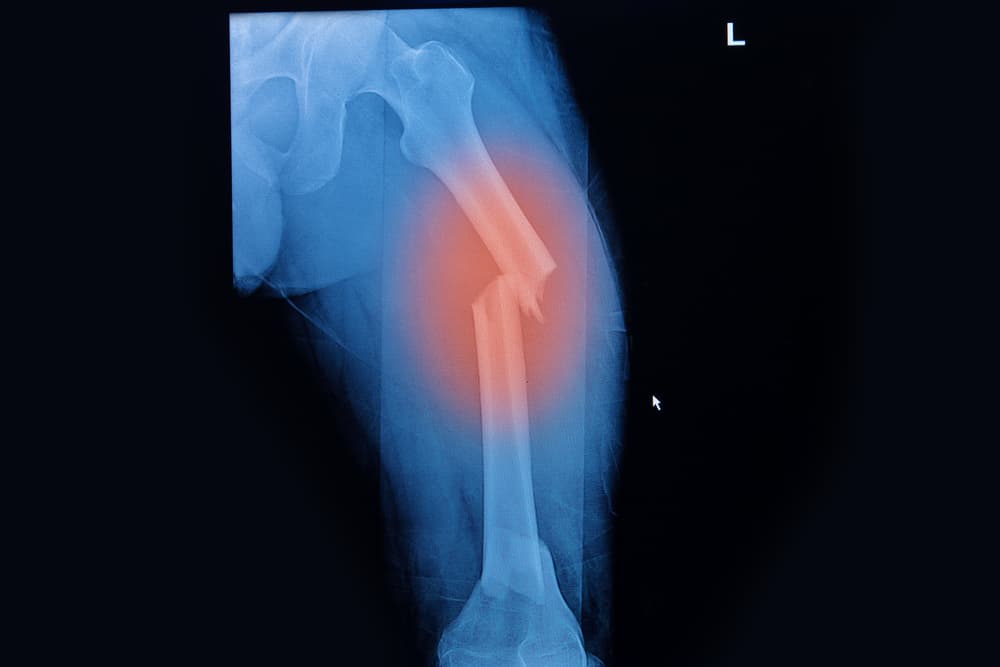 Fosamax Lawsuit Femure Fracture Risks Complications