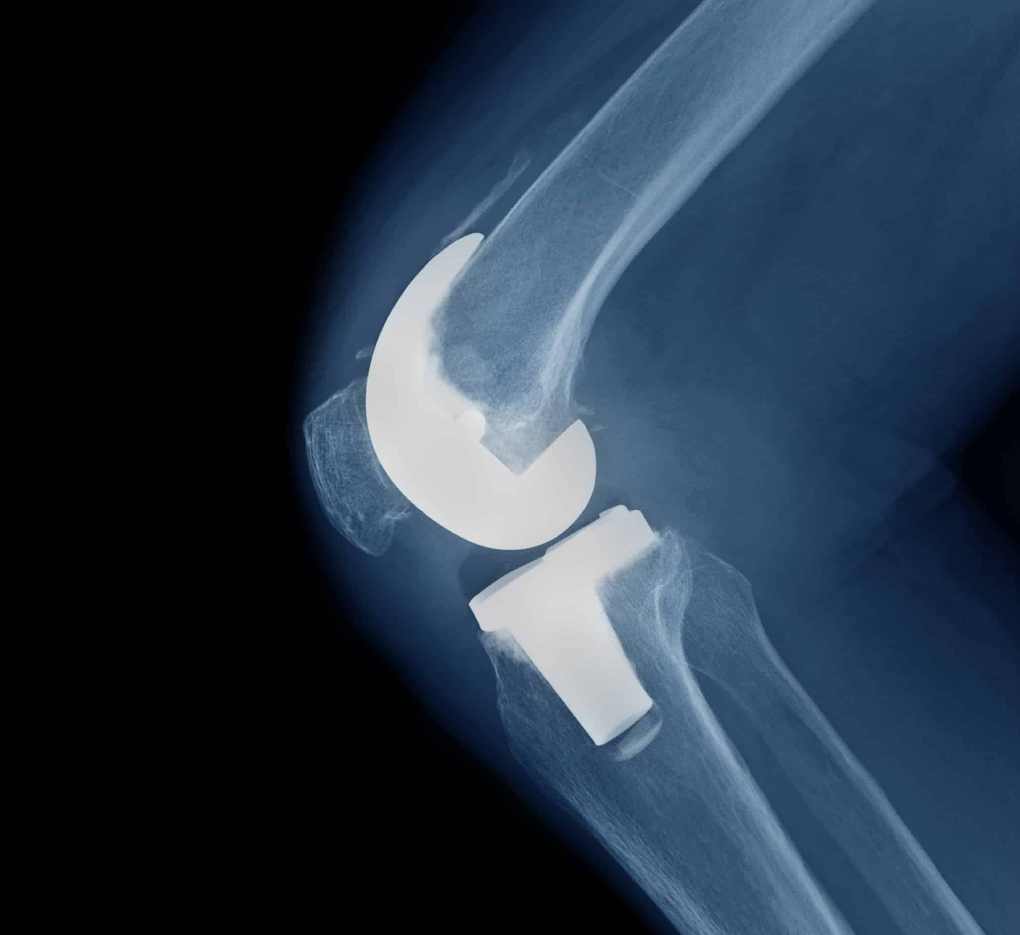 Exactech Knee & Ankle Lawsuit - Joint Implant Failure